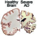 Alzheimer's deterioration