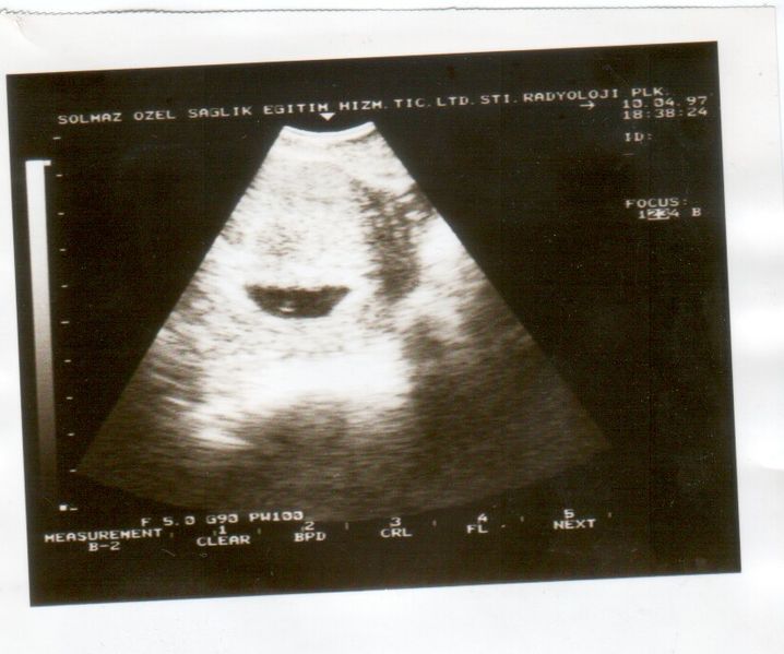 File:Ultrasound Scan ND 166.jpg