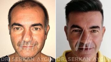 Bild zum Artikel Haartransplantation in der Türkei