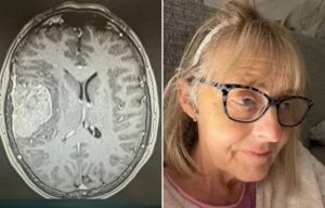 Doctors told me I had anxiety but it was a brain tumour - don't ignore the signs