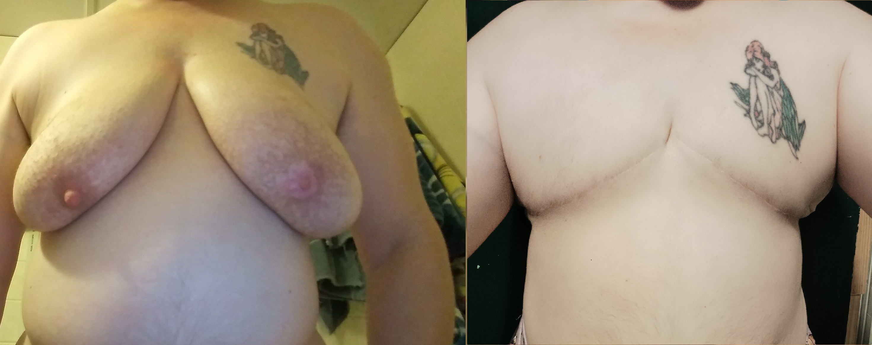 3 Year De-Boobaversary Side-by-Side Comparison