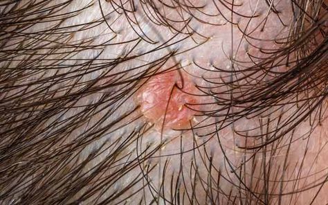 Scalp folliculitis is an inflammatory disorder of the hair follicles in the scalp. Its symptoms include small and itchy red bumps. It feels like acne breakout on the scalp. Scalp Folliculitis, Scalp Bumps, Unwanted Hair Removal, Sores On Scalp, Hair Follicles, Unwanted Hair, Itchy Scalp, Scalp Acne