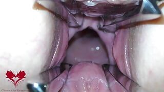 A boceta da amante é aberta com um expansor de buraco para que você possa estudar seu colo do útero.