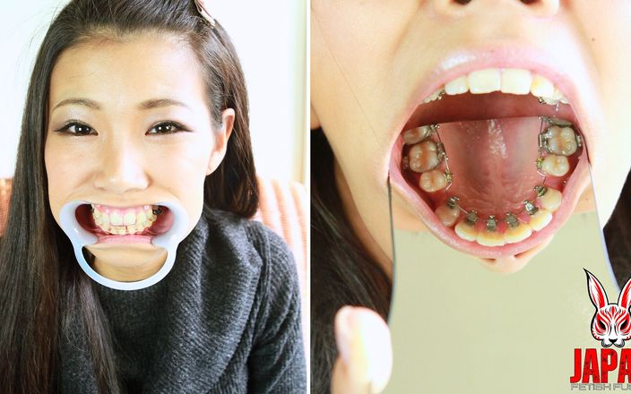 Japan Fetish Fusion: Obsesia ortotozei: Călătoria mea cu aparat dentar