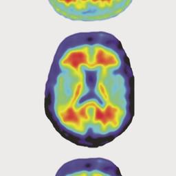Alzheimer-Forschung - Gehirnforschung
