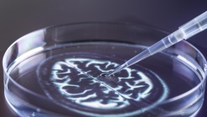 Wie Alzheimer-Biomarker die Therapie verbessern sollen