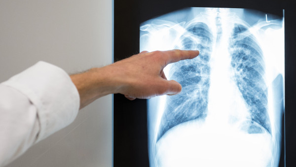 Berlin: Ein Arzt zeigt im Vivantes Klinikum Neukölln auf das Röntgenbild einer Lunge. (Symbolbild)