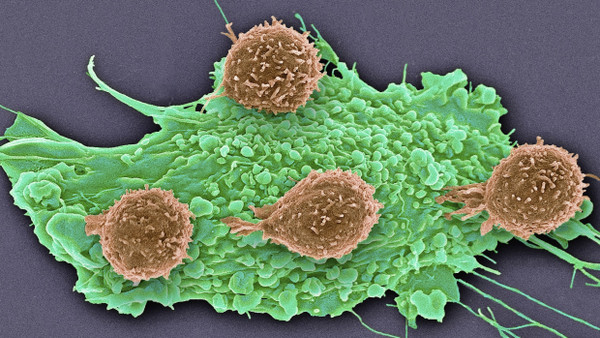 Rasterelektronenmikroskopaufnahme von T-Lymphozyten an einer Tumorzelle.