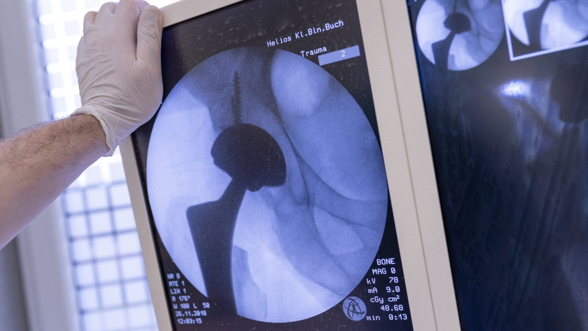 Künstliches Hüftgelenk im Röntgenbild. Operationen an Gelenken sind so schmerzhaft, dass Ärzte gelegentlich Opioide für die Zeit danach verschreiben.