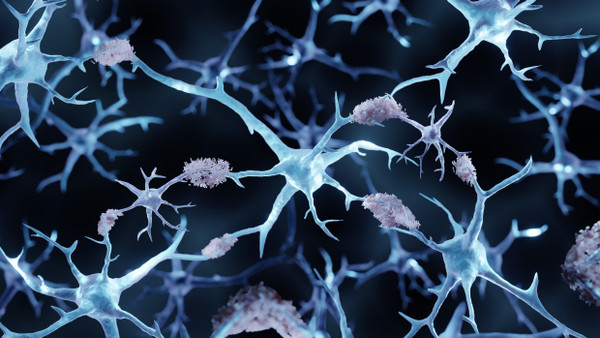 Bei der Alzheimer-Krankheit bilden sich Amyloid-Plaques, die den Stoffwechsel der Nervenzellen stören.